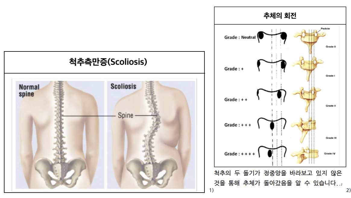 척추측만증과 추체의 회전